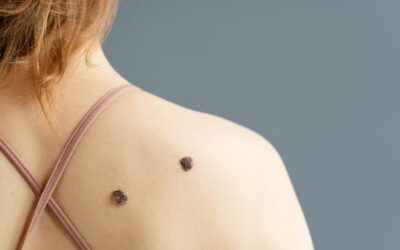 Dermatología: Cuando se debe revisar un lunar: Causas, señales de alerta y cuidados